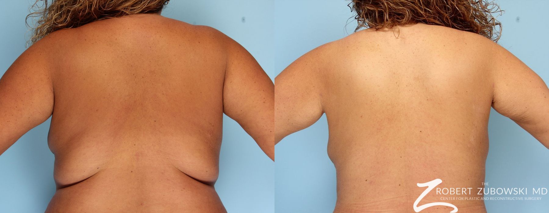 Liposuction - Case 3530