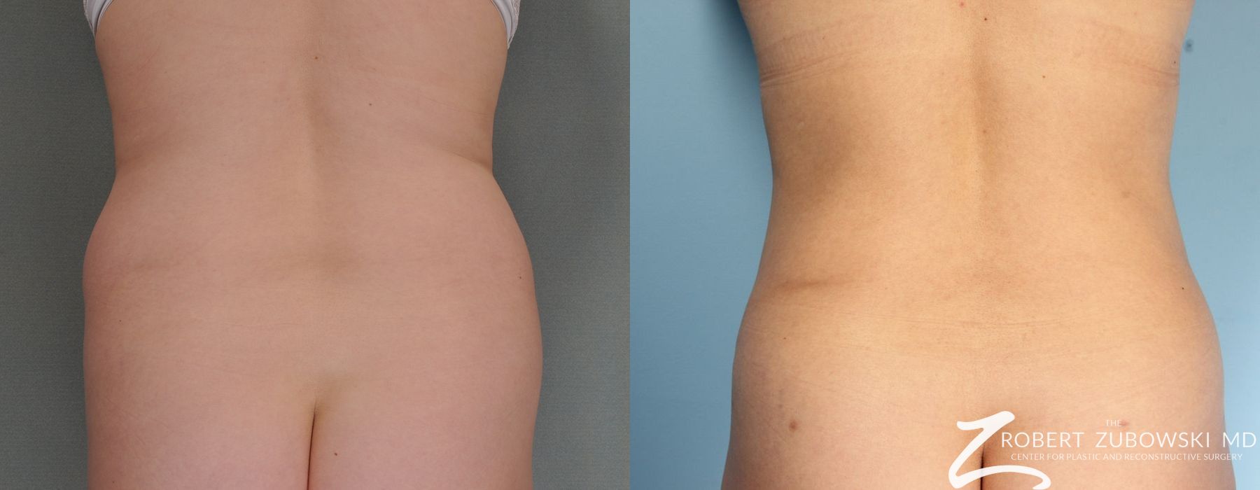 Liposuction - Case 3529