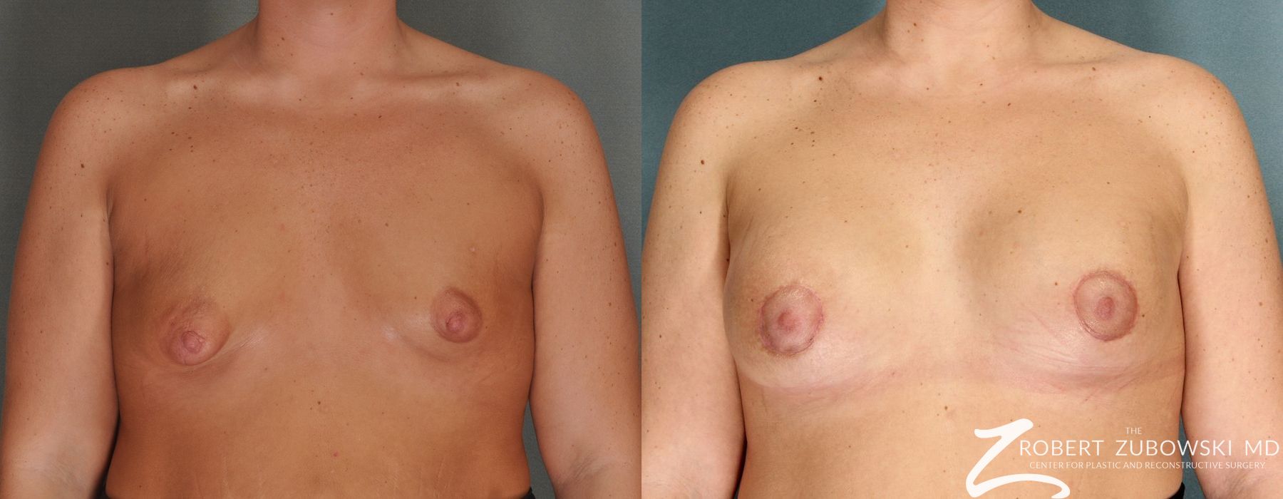 Breast Lift and Augmentation - Case 3669