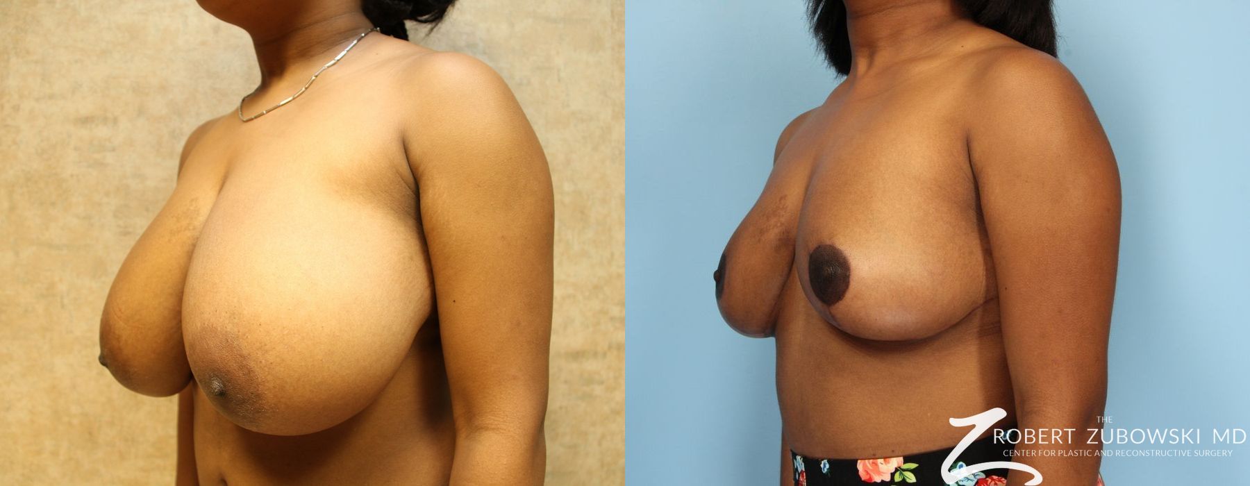 Breast Reduction - Thumbnail 2