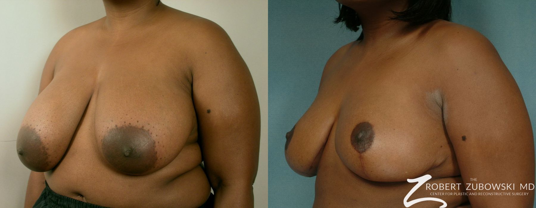 Breast Reduction - Thumbnail 2
