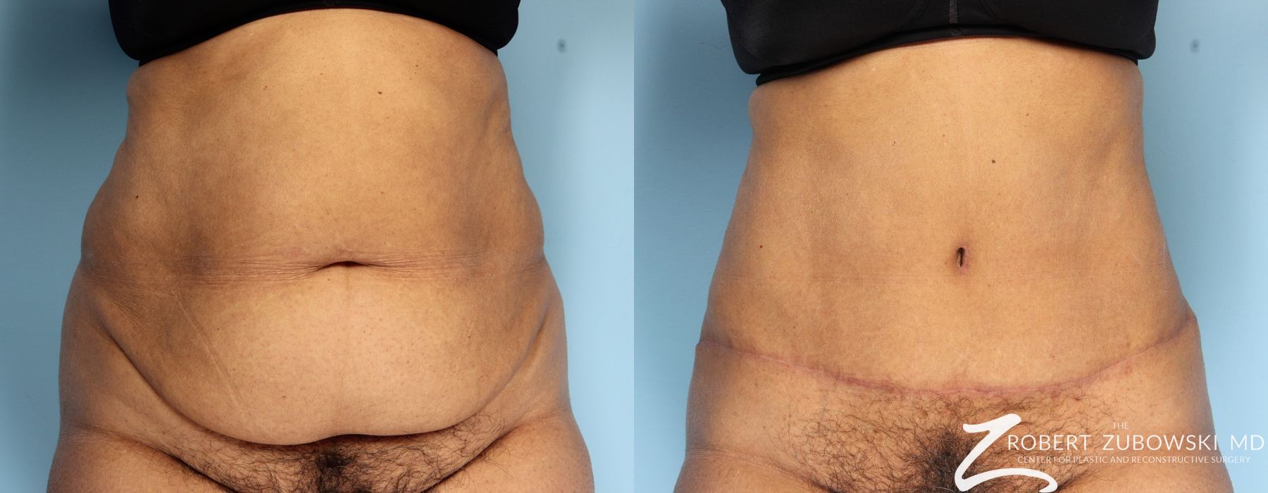 Tummy Tuck - Case 3593