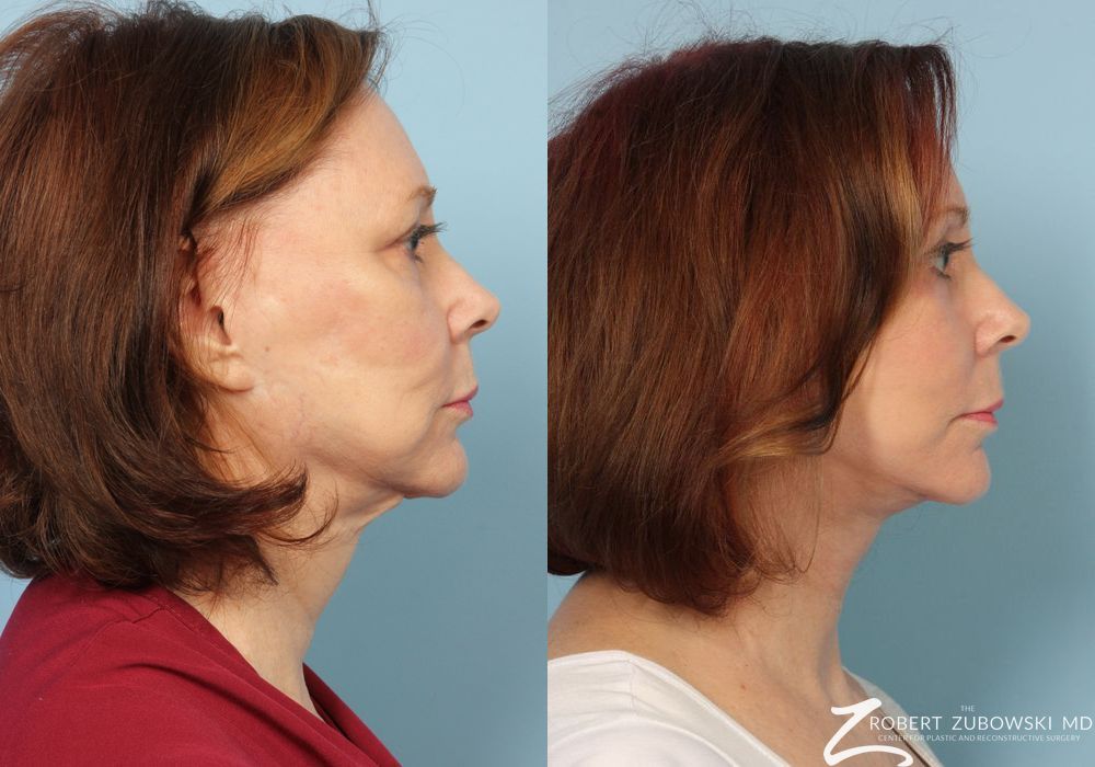 Facelift - Thumbnail 2