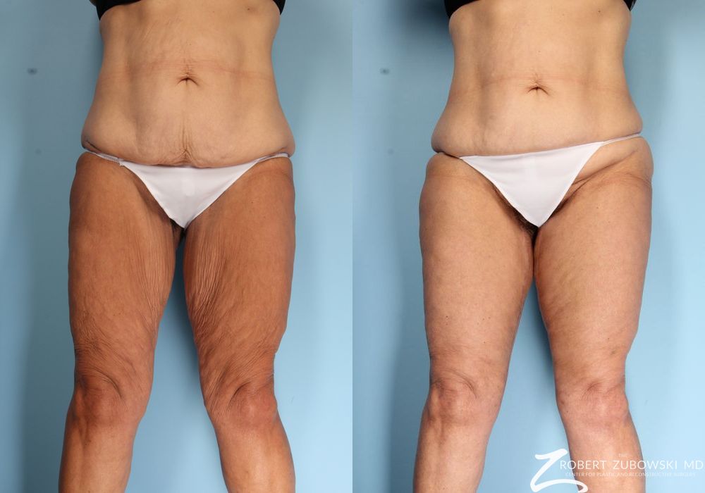 Thigh Lift - Case 3573