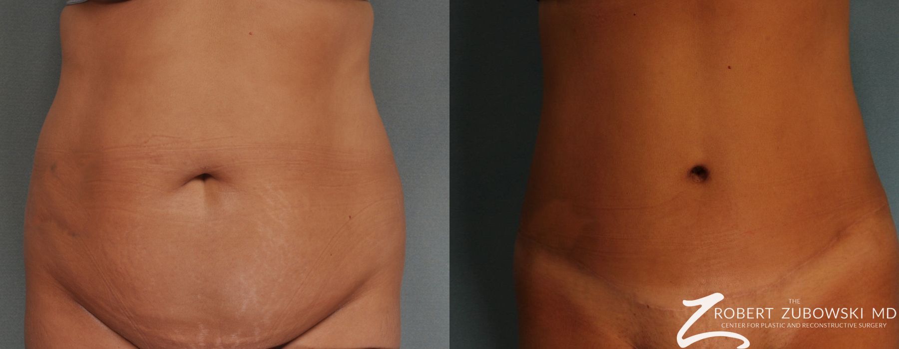 Tummy Tuck - Case 3596