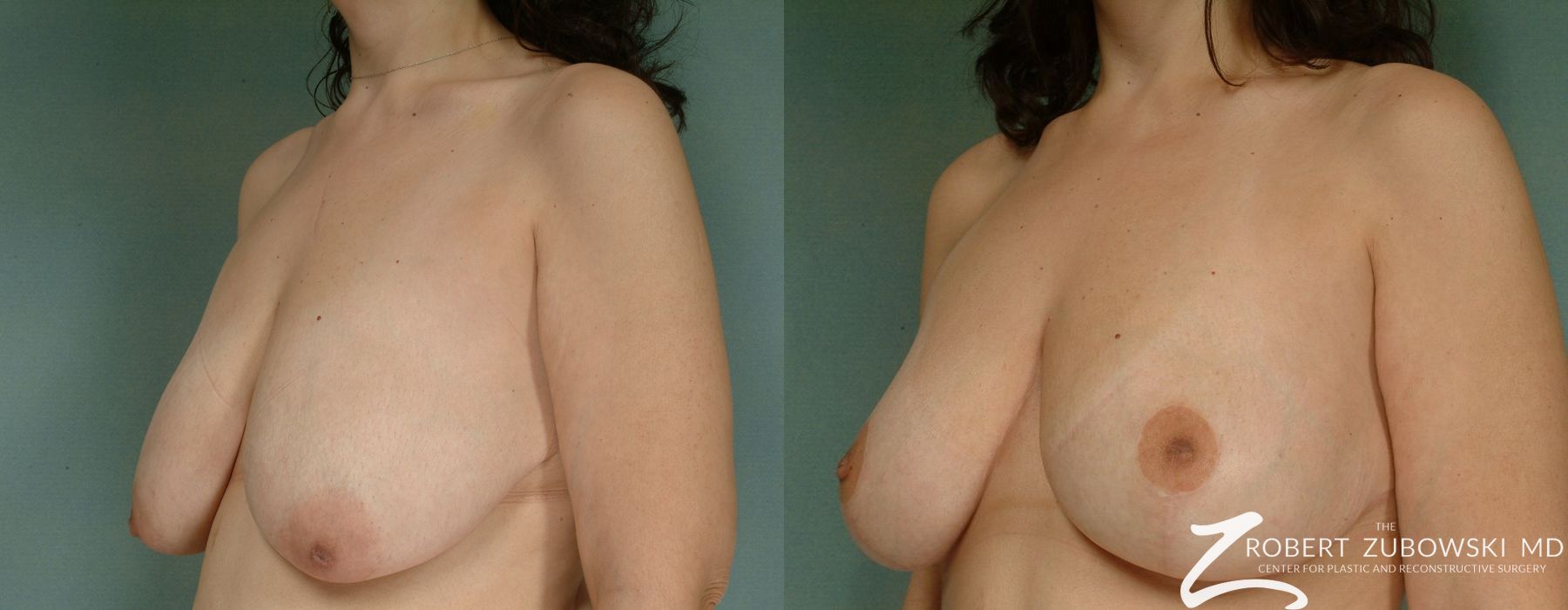Breast Lift - Thumbnail 2