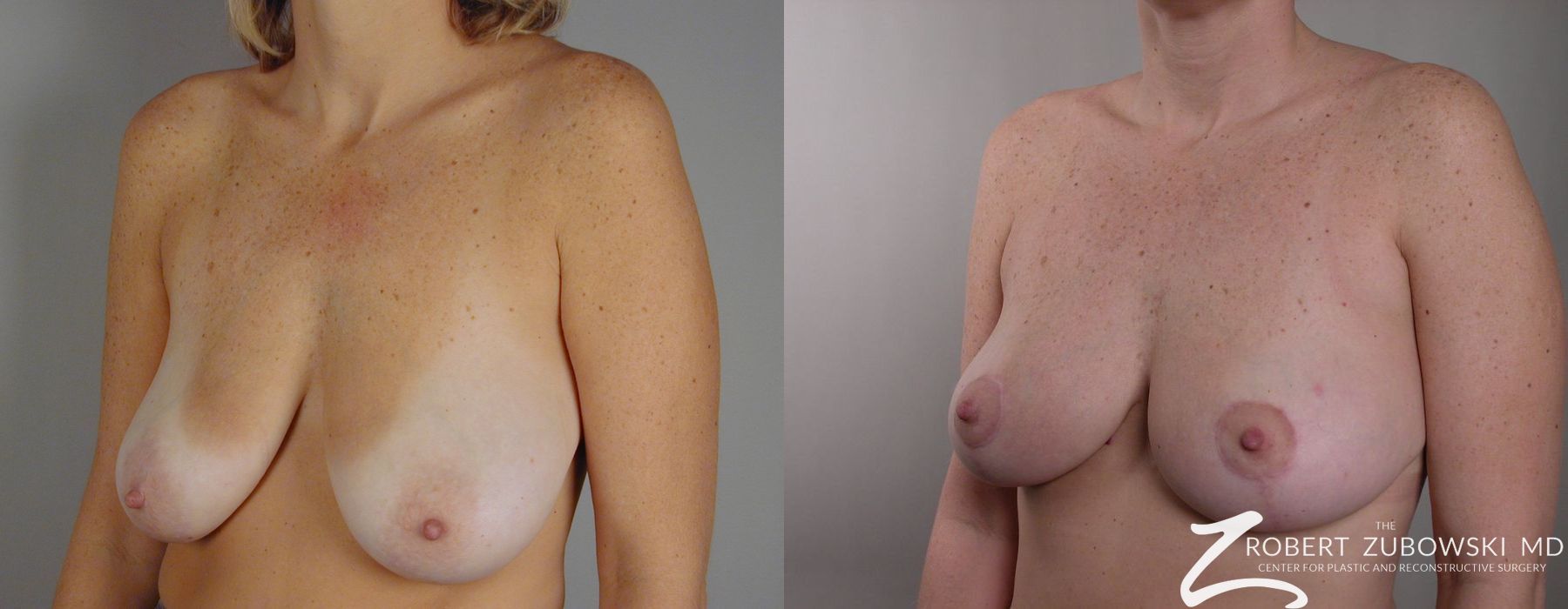 Breast Lift - Thumbnail 2