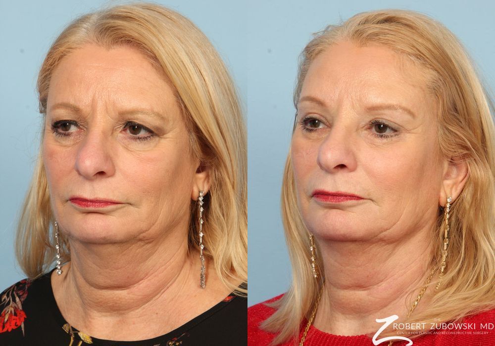 Blepharoplasty - Thumbnail 2