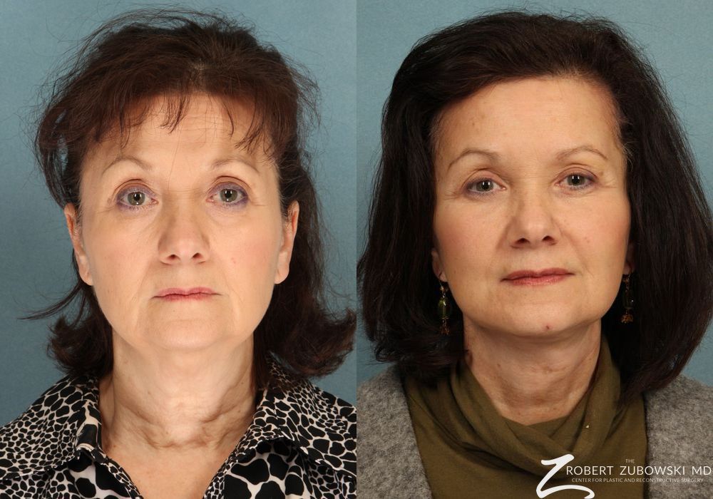 Facelift - Case 3816