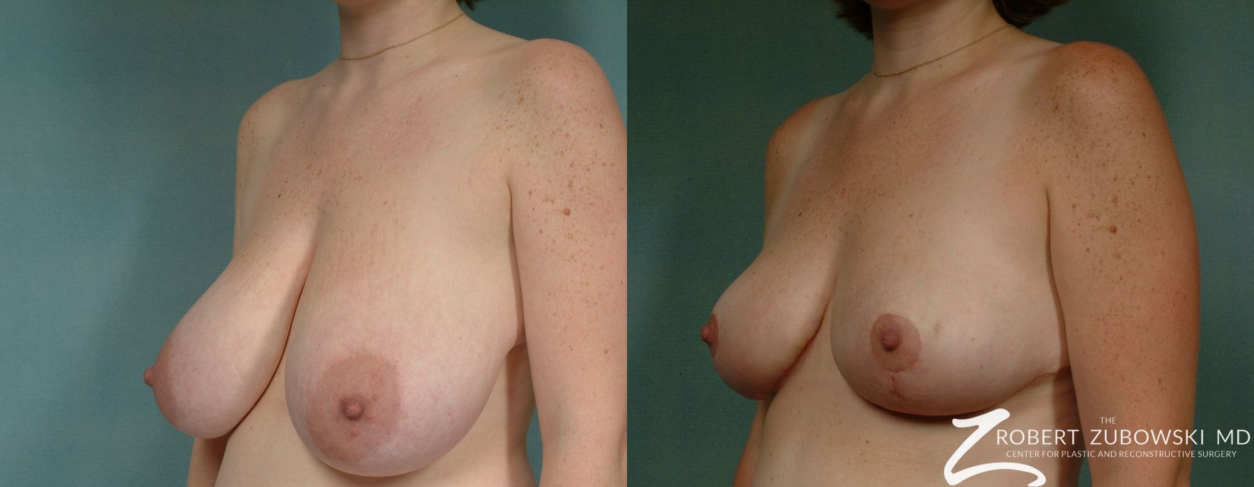 Breast Lift - Thumbnail 2