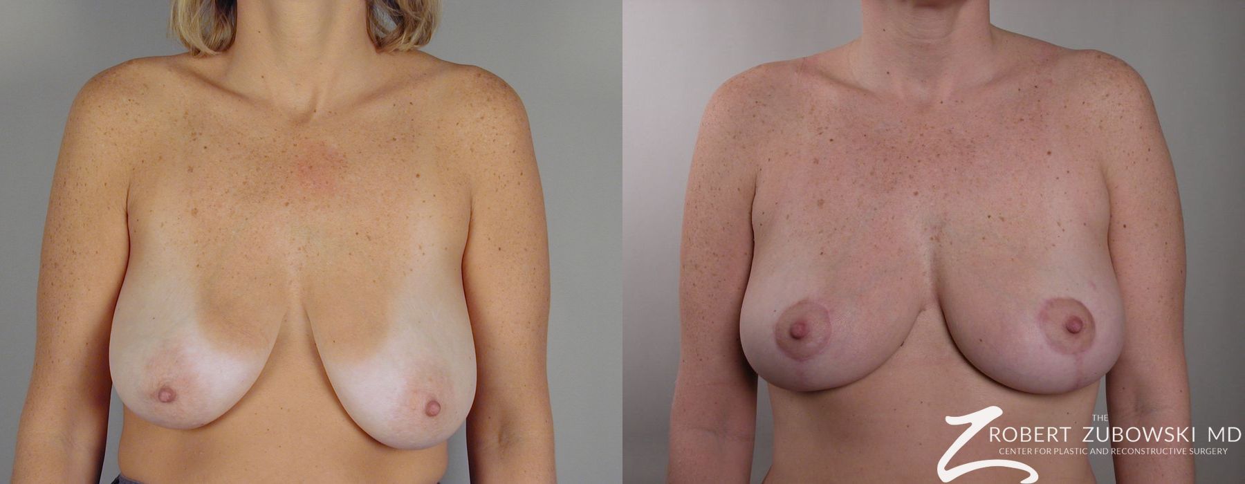 Breast Lift - Case 3659