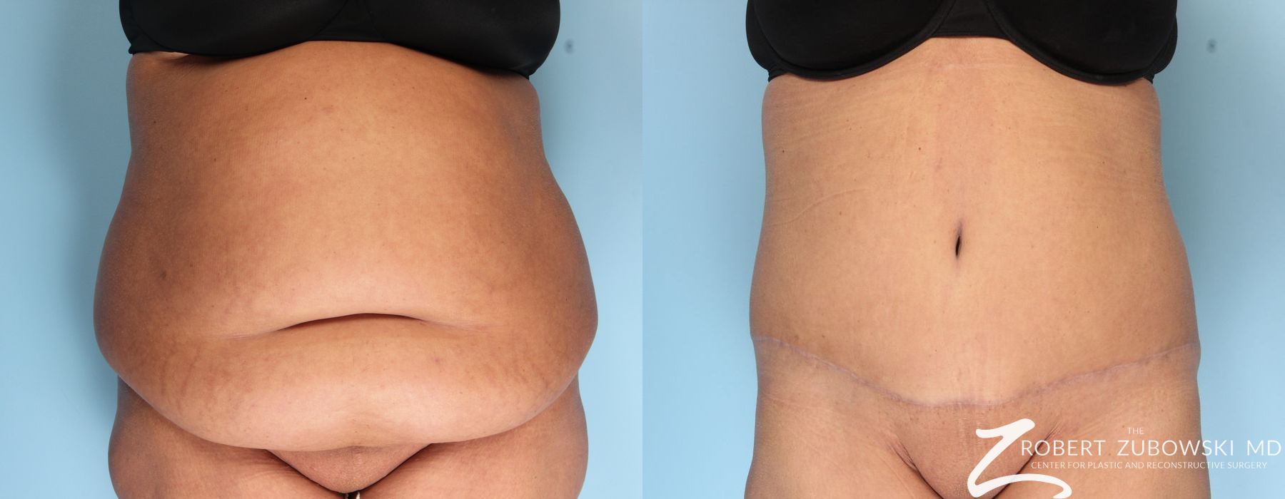 Tummy Tuck - Case 3594