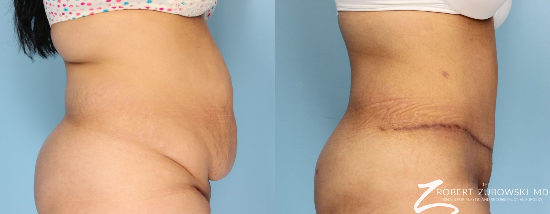 Tummy Tuck - Thumbnail 2