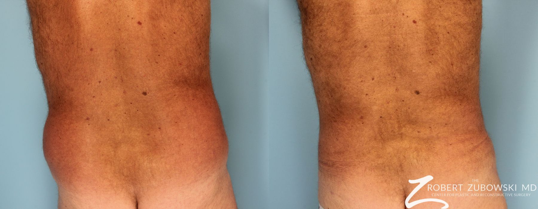 Liposuction - Thumbnail 2