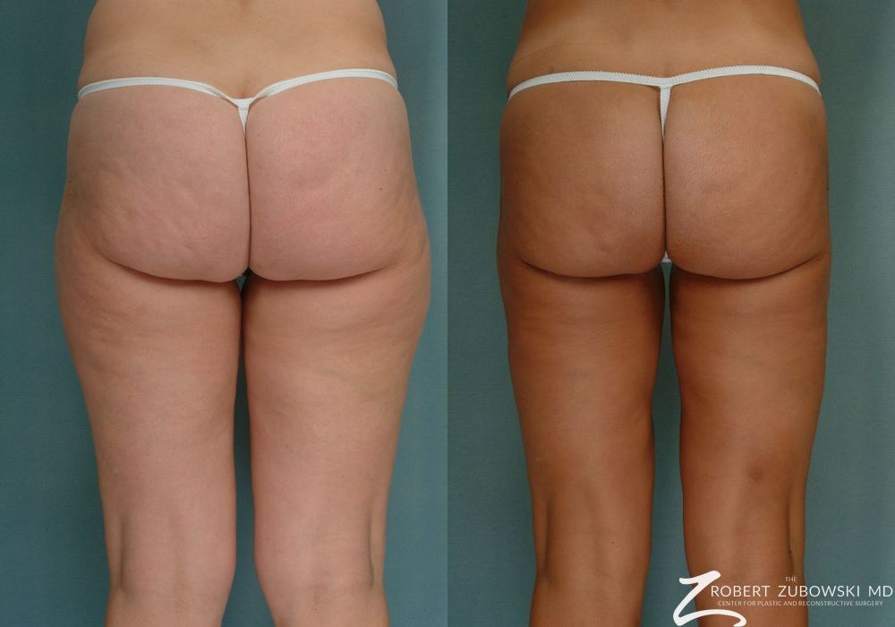 Liposuction - Thumbnail 2