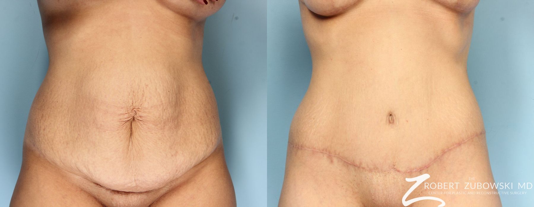 Tummy Tuck - Case 3600