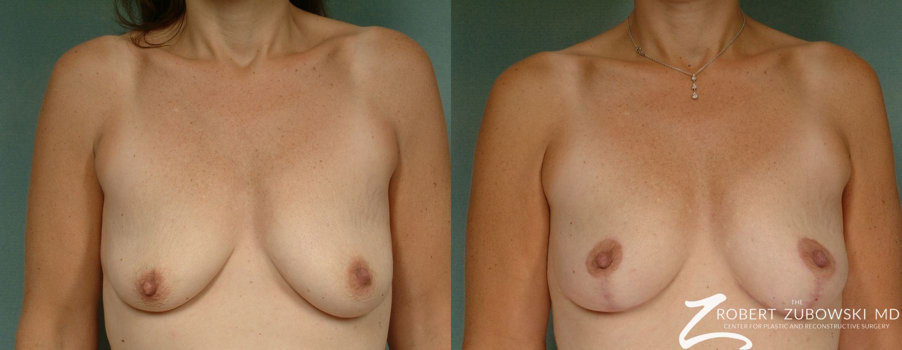 Breast Lift - Case 3662