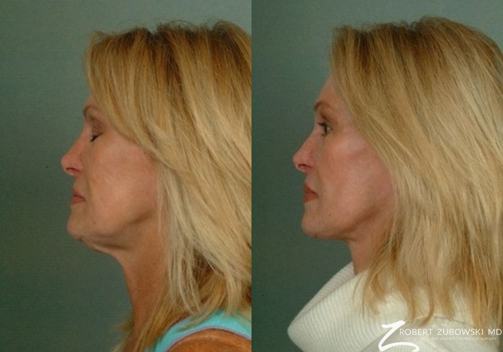 Facelift - Thumbnail 2