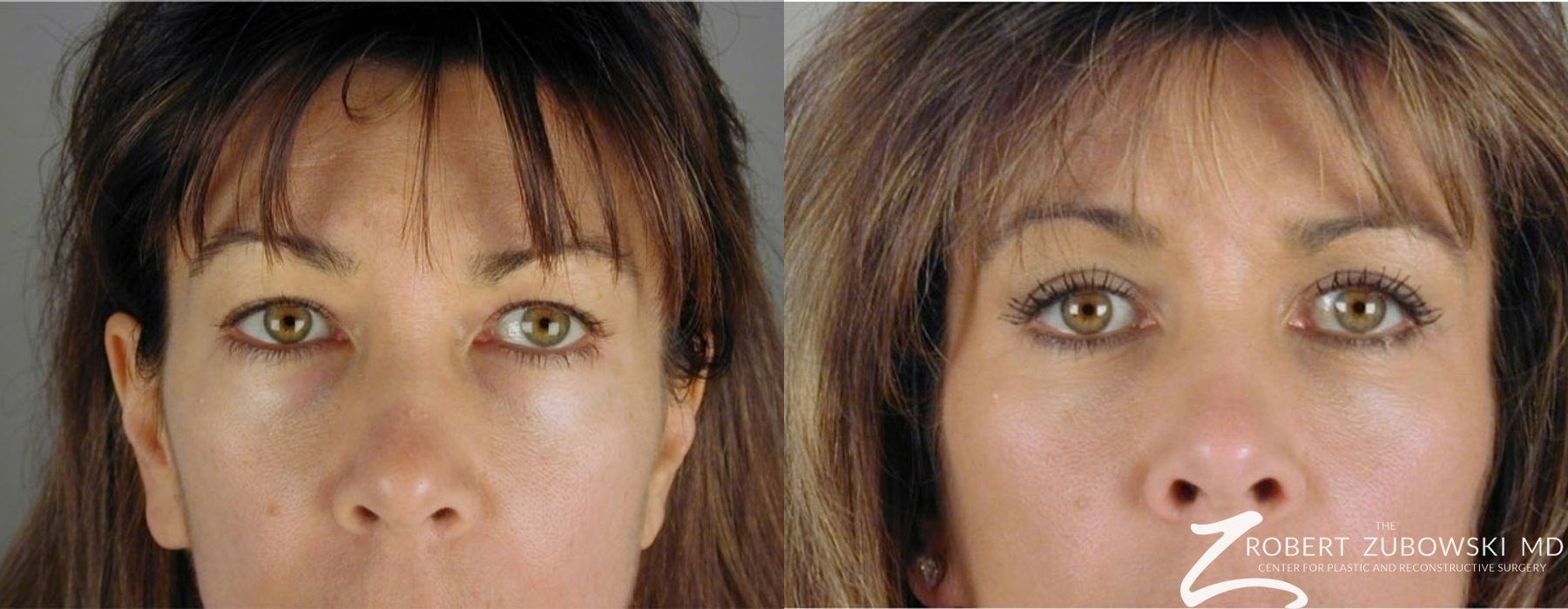 Blepharoplasty - Case 3771
