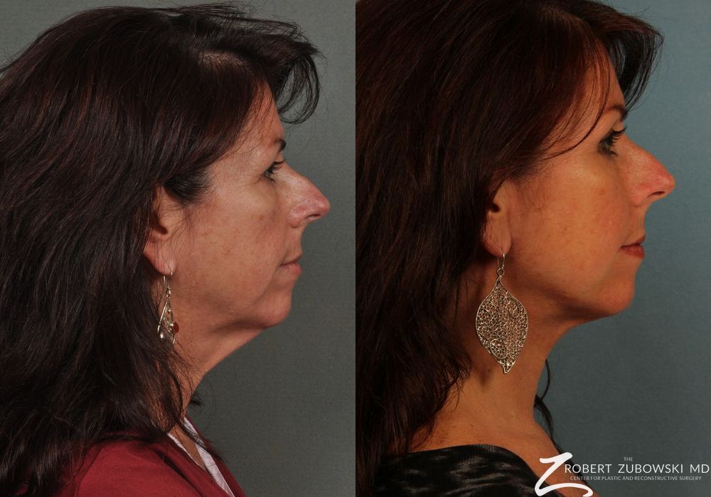 Neck Lift - Thumbnail 2