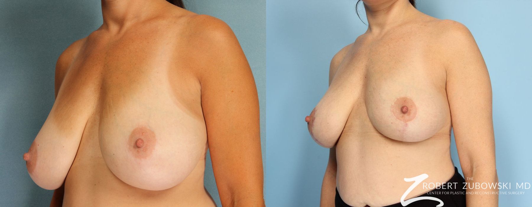 Breast Reduction - Thumbnail 2
