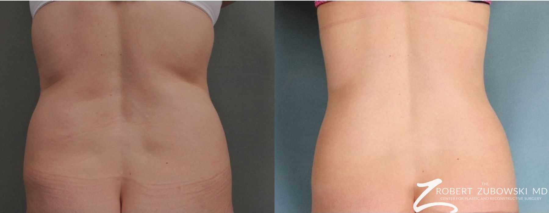 Liposuction - Case 3557