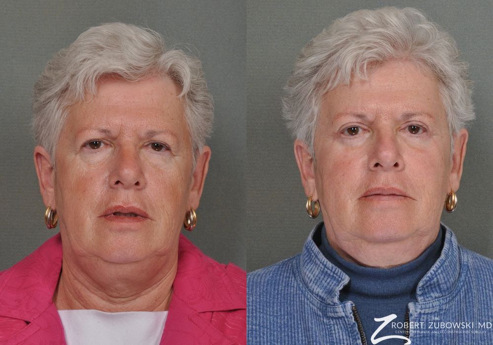 Blepharoplasty - Case 3755