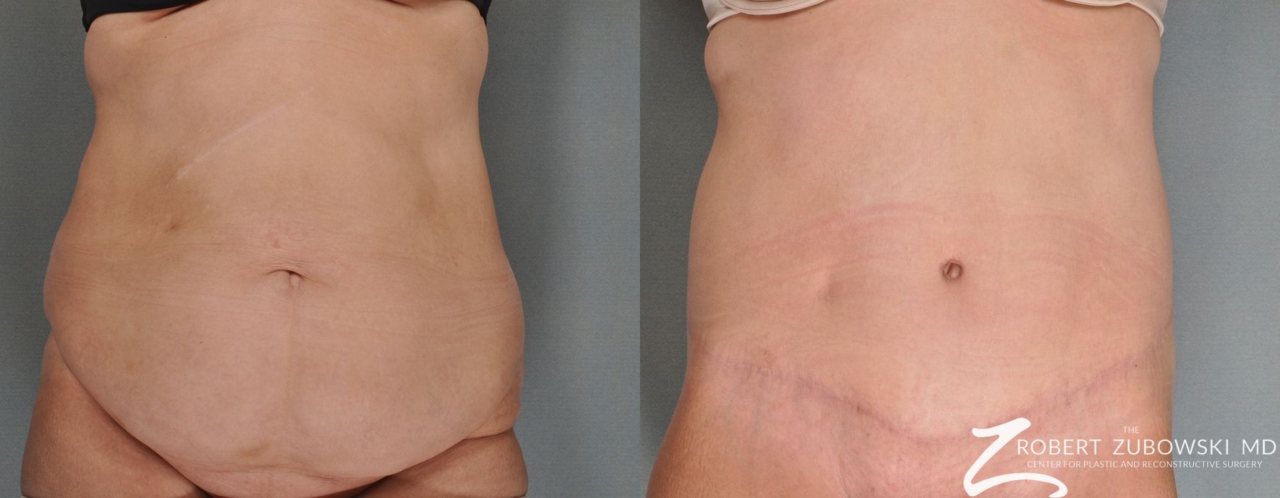 Tummy Tuck - Case 3579