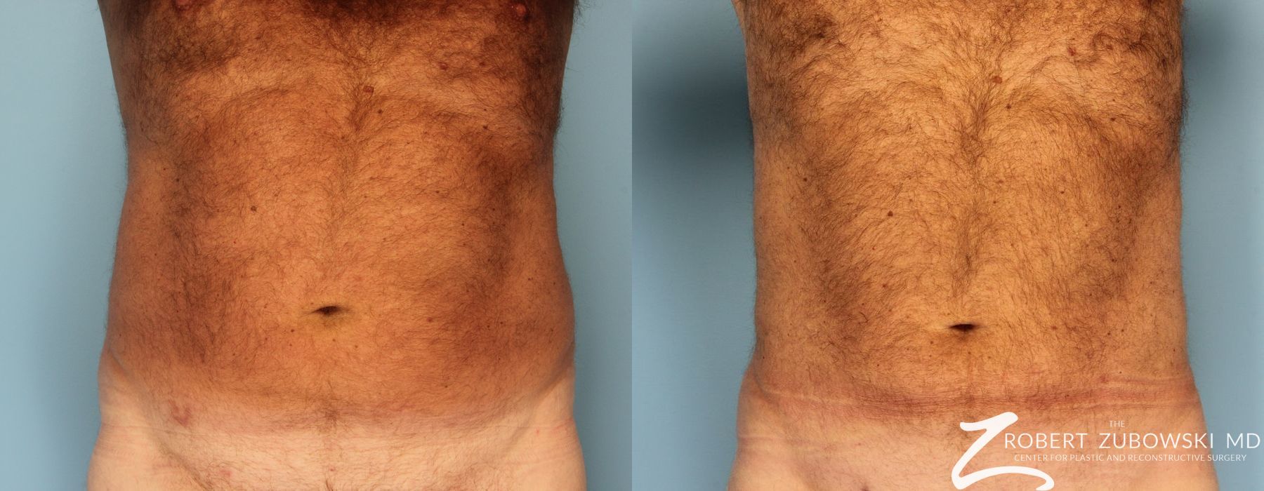 Liposuction - Thumbnail 3