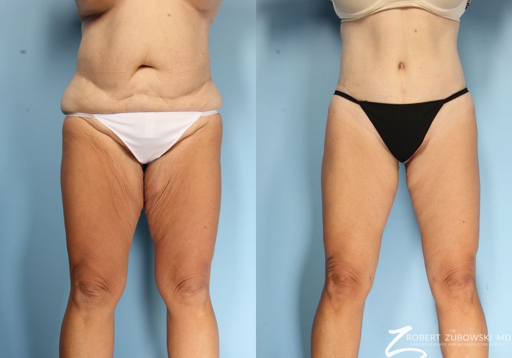 Thigh Lift - Case 3575