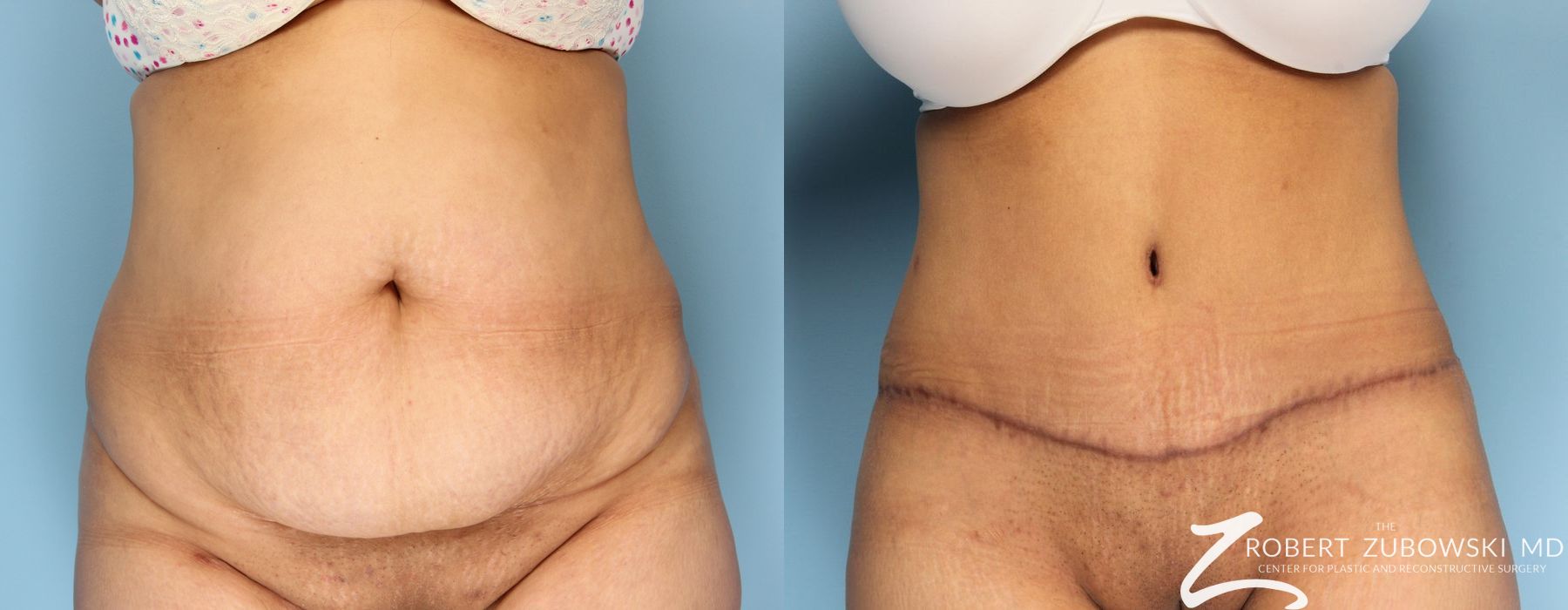 Tummy Tuck - Case 3590