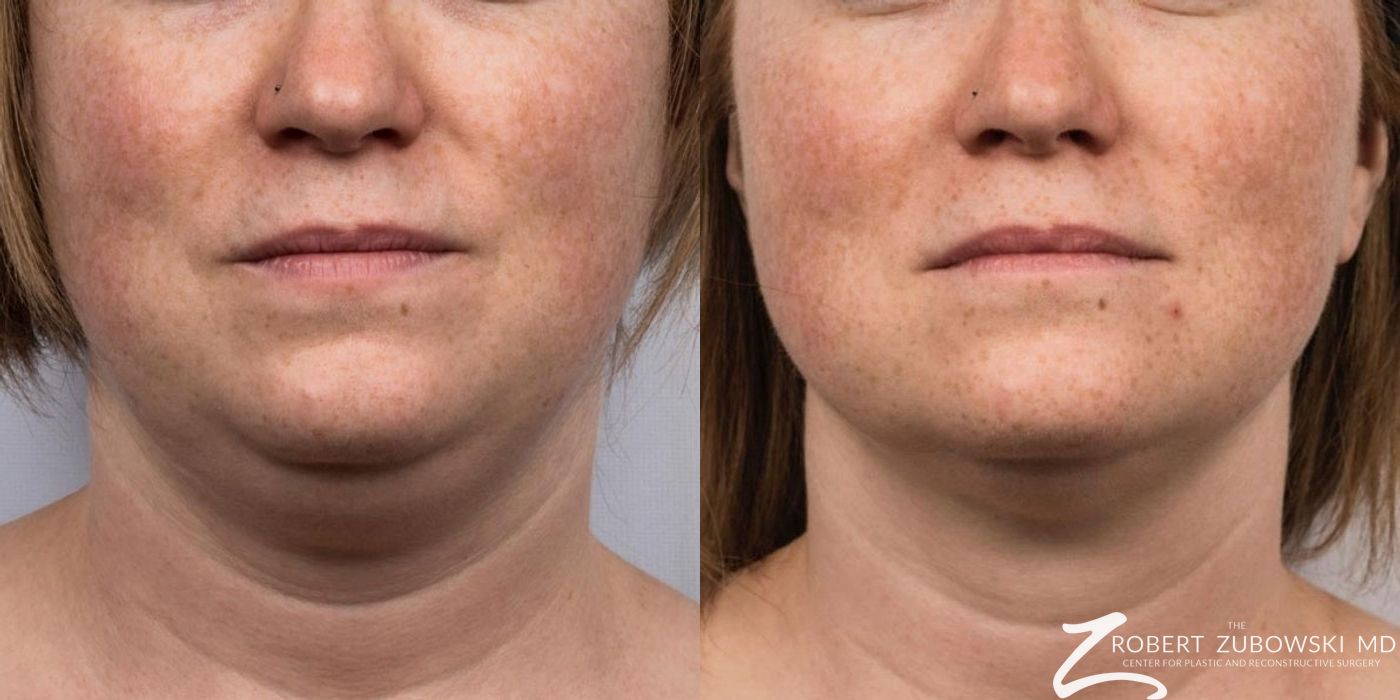 CoolSculpting® - Case 3905