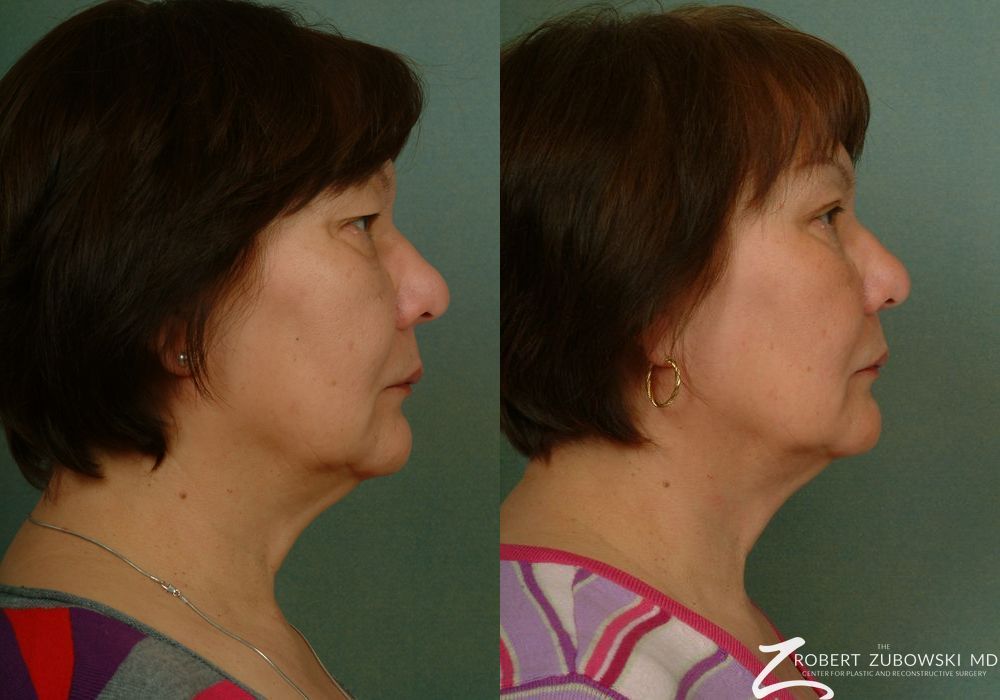 Blepharoplasty - Thumbnail 2