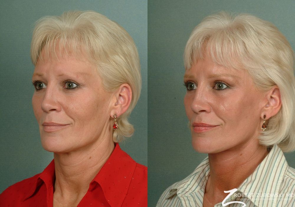 Facelift - Thumbnail 2