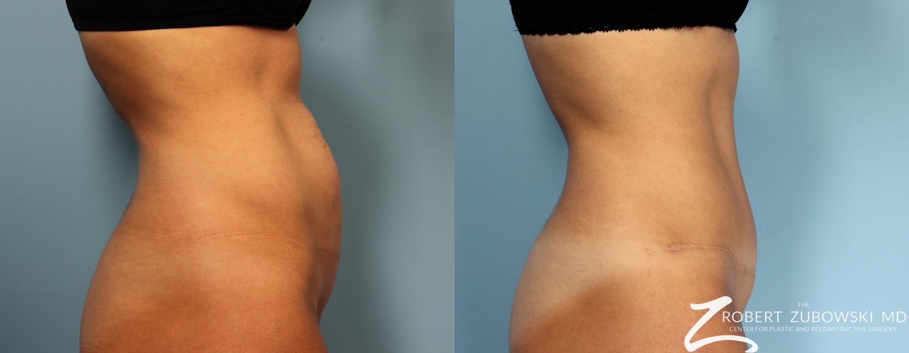 Tummy Tuck - Thumbnail 2