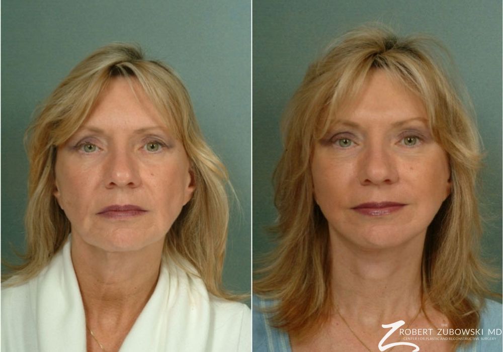 Brow Lift - Case 3783