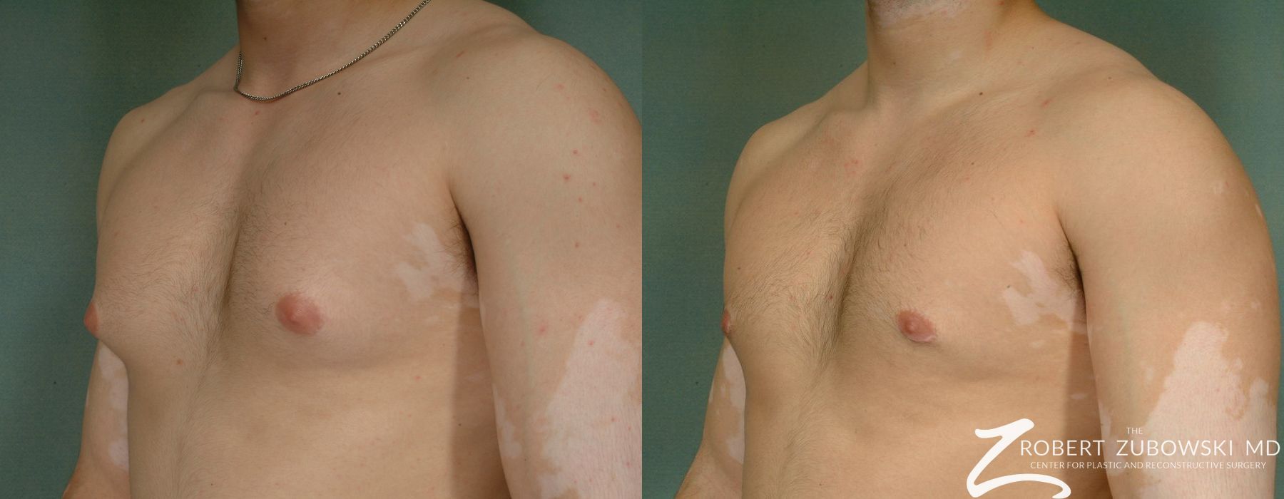 Gynecomastia - Thumbnail 2