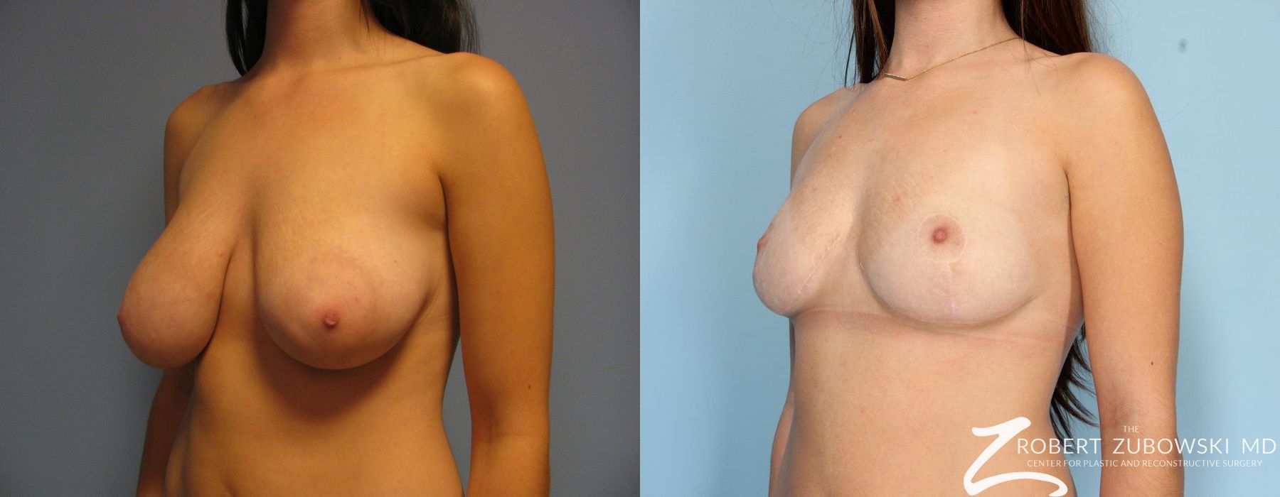 Breast Lift - Thumbnail 2