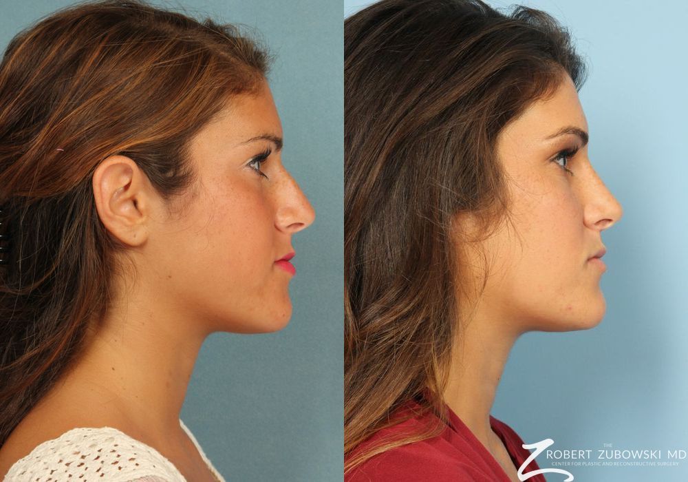 Rhinoplasty - Thumbnail 2