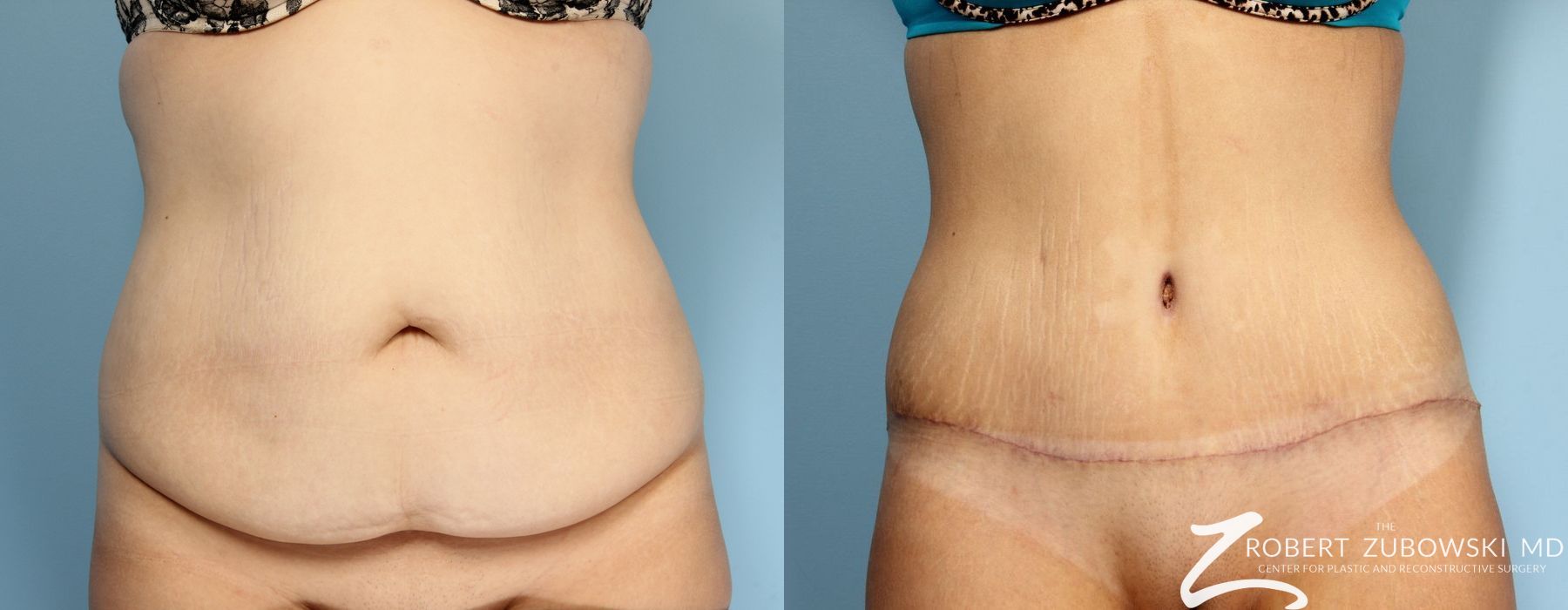 Tummy Tuck - Case 3592