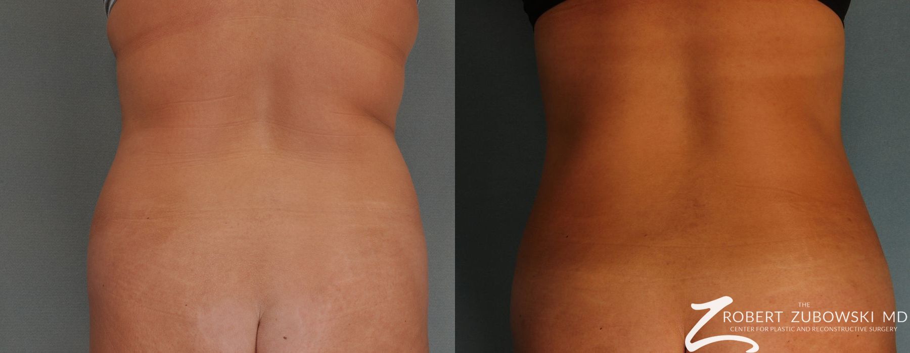 Liposuction - Case 3541