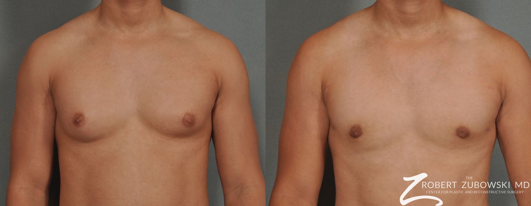 Gynecomastia - Case 3726
