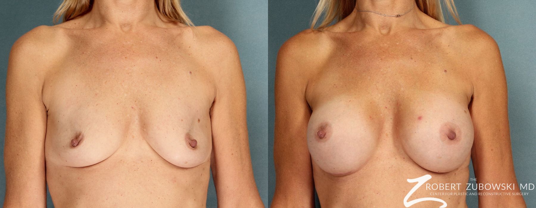 Before and after procedure result