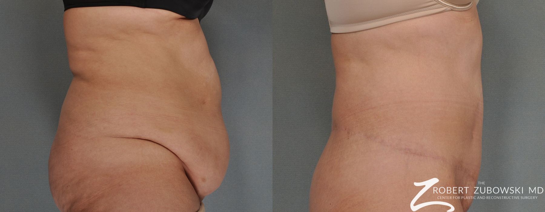 Tummy Tuck - Thumbnail 2