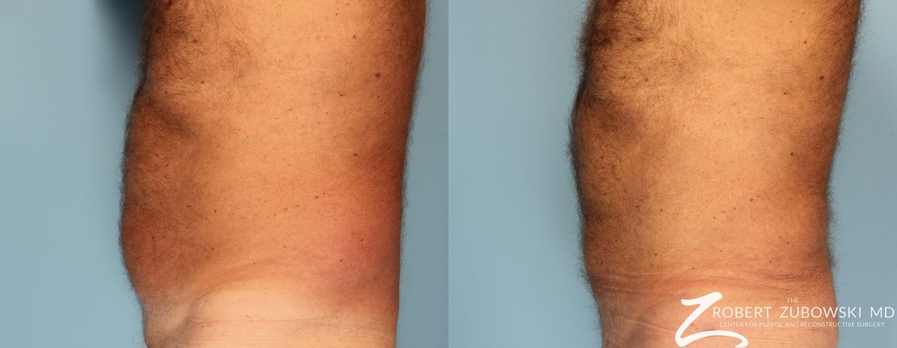 Liposuction - Case 3539