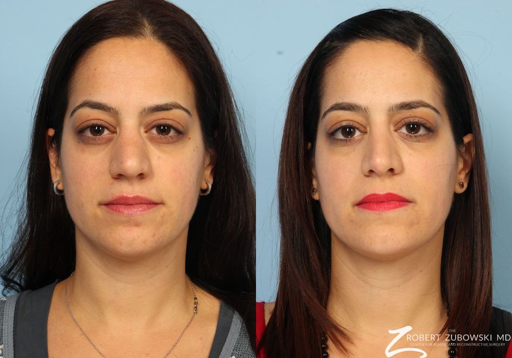Rhinoplasty - Case 3893