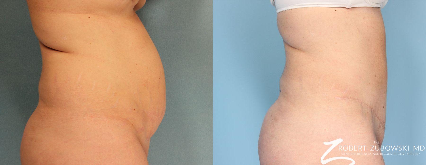 Tummy Tuck - Thumbnail 2