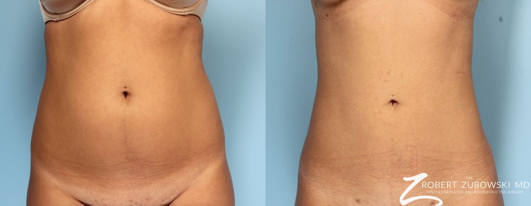 Liposuction - Case 3532