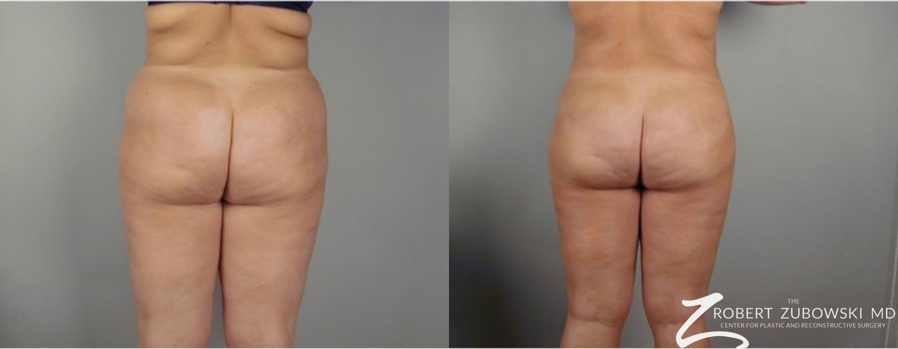 Liposuction - Thumbnail 3