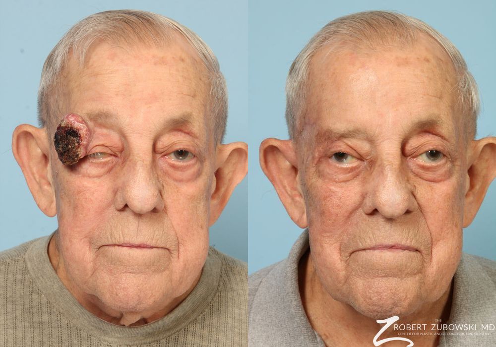 Mohs Closure - Thumbnail 2